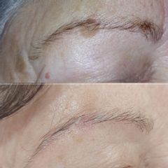 Eliminación manchas cara