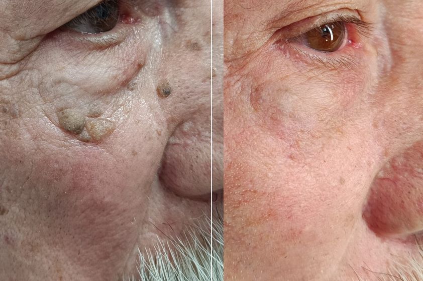 Xantelasmas antes y después - 878644