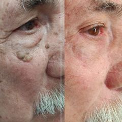 Eliminación xantelasmas y verrugas con láser plasma