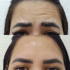Clínica Lasernova - Eliminación de arrugas