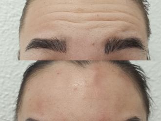 Eliminación arrugas antes y después - 881171