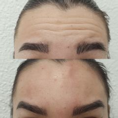 Clínica Lasernova - Eliminación de arrugas
