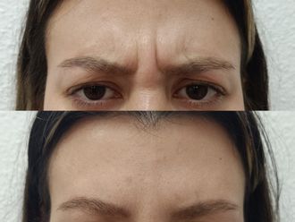 Eliminación arrugas antes y después - 881172