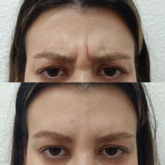 Clínica Lasernova - Eliminación de arrugas