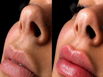 Aumento labios antes y después - 881199