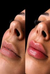 Clínica Lasernova - Aumento de labios