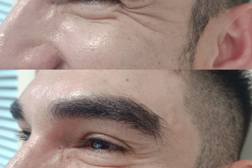 Eliminación arrugas antes y después - 881200