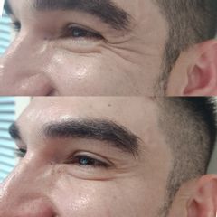 Clínica Lasernova - Eliminación de arrugas