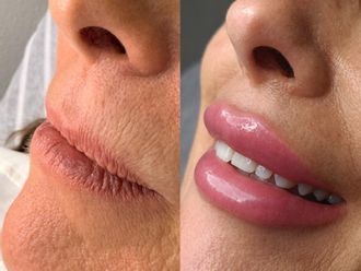 Aumento labios antes y después - 881201