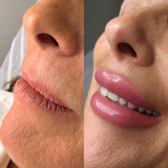 Clínica Lasernova - Aumento de labios