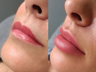 Aumento labios antes y después - 881202