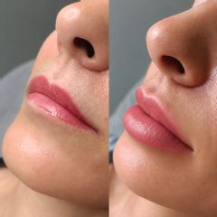Clínica Lasernova - Aumento de labios