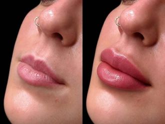 Aumento labios antes y después - 881449
