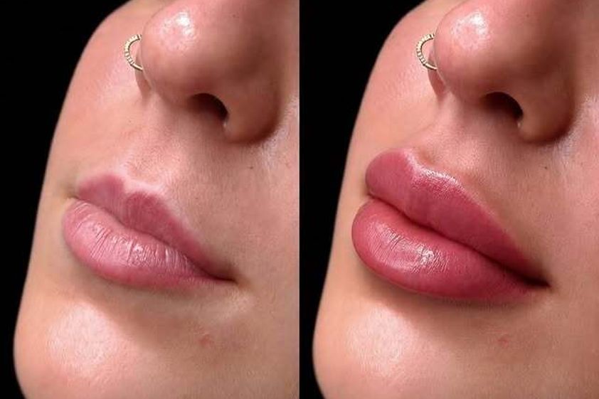 Aumento labios antes y después - 881449