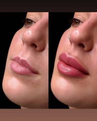 Aumento de labios