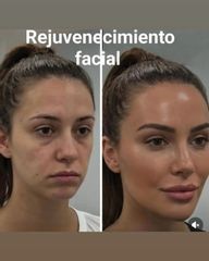 Rejuvenecimiento facial