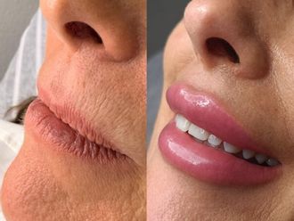 Aumento labios antes y después - 881451