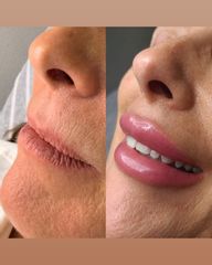 Aumento de labios