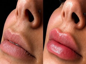 Aumento labios antes y después - 881452