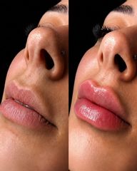 Aumento e labios