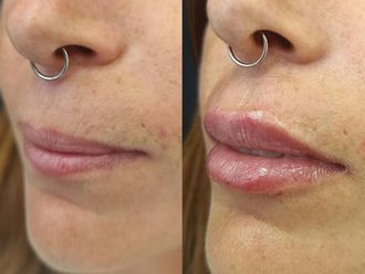 Aumento labios antes y después - 881453