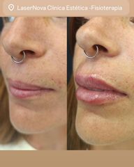 Aumento de labios