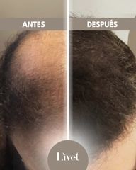 Transplantes capilares - Livet
