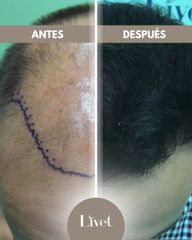 Transplantes capilares - Livet