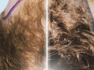 Trasplantes capilares antes y después - 877342