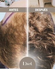 Transplantes capilares - Livet