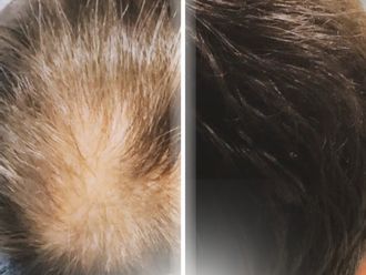 Trasplantes capilares antes y después - 877343