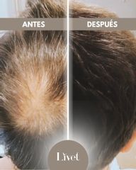 Transplantes capilares - Livet