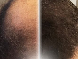 Trasplantes capilares antes y después - 877344