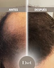 Transplante capilar - Livet
