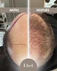 Transplantes capilares - Livet