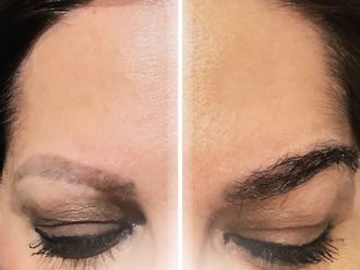 Trasplantes capilares antes y después - 877346