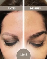 Transplantes capilares - Livet