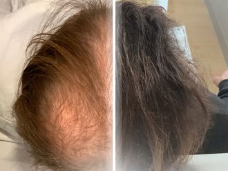 Trasplantes capilares antes y después - 877347