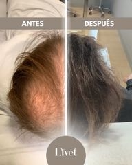 Transplantes capilares - Livet