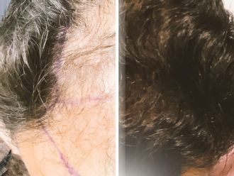 Trasplantes capilares antes y después - 877348