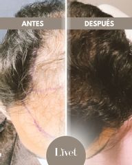 Transplantes capilares - Livet