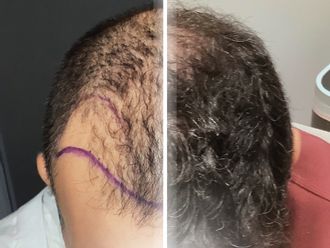 Trasplantes capilares antes y después - 877349