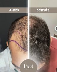 Transplantes capilares - Livet