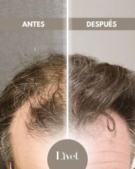 Transplantes capilares - Livet