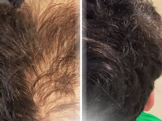 Trasplantes capilares antes y después - 877351