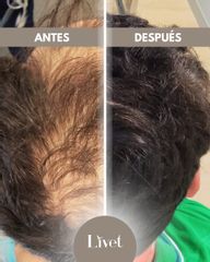 Transplantes capilares - Livet