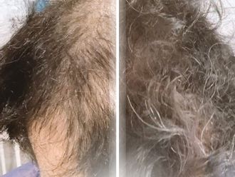 Trasplantes capilares antes y después - 877352