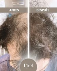 Transplantes capilares - Livet