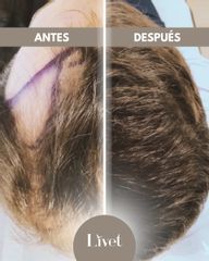 Transplantes capilares - Livet