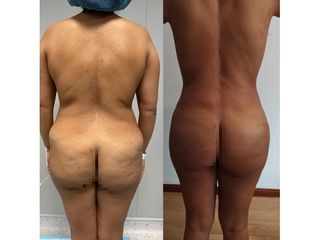Liposucción - Dr. Quintero